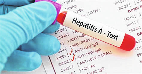 Darke County Health Department reports 5 cases of Hepatitis A